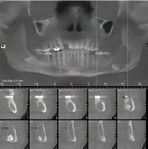 x-ray of teeth