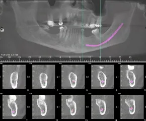 x-ray of teeth